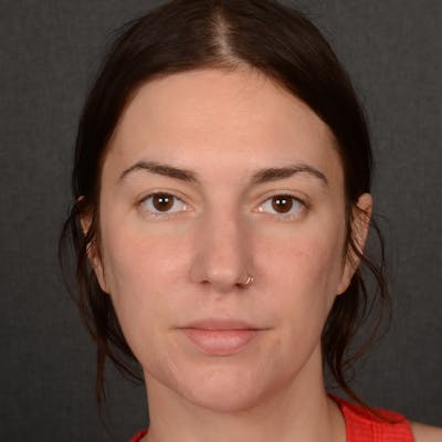 Female Rhinoplasty Before & After Gallery - Patient 259908 - Image 1