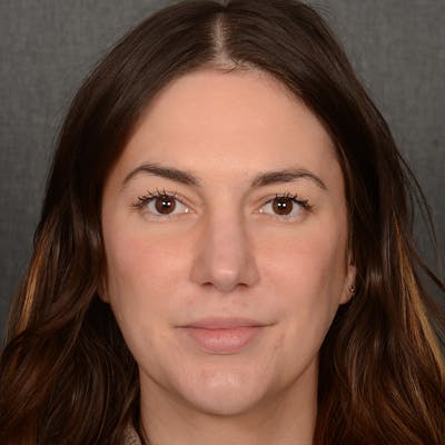 Female Rhinoplasty Before & After Gallery - Patient 259908 - Image 2