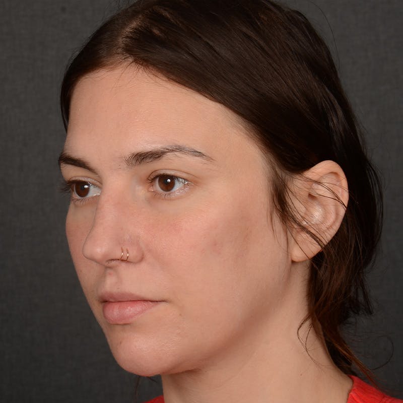 Female Rhinoplasty Before & After Gallery - Patient 259908 - Image 3