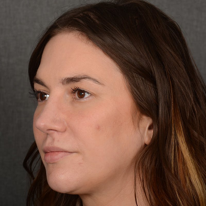 Female Rhinoplasty Before & After Gallery - Patient 259908 - Image 4