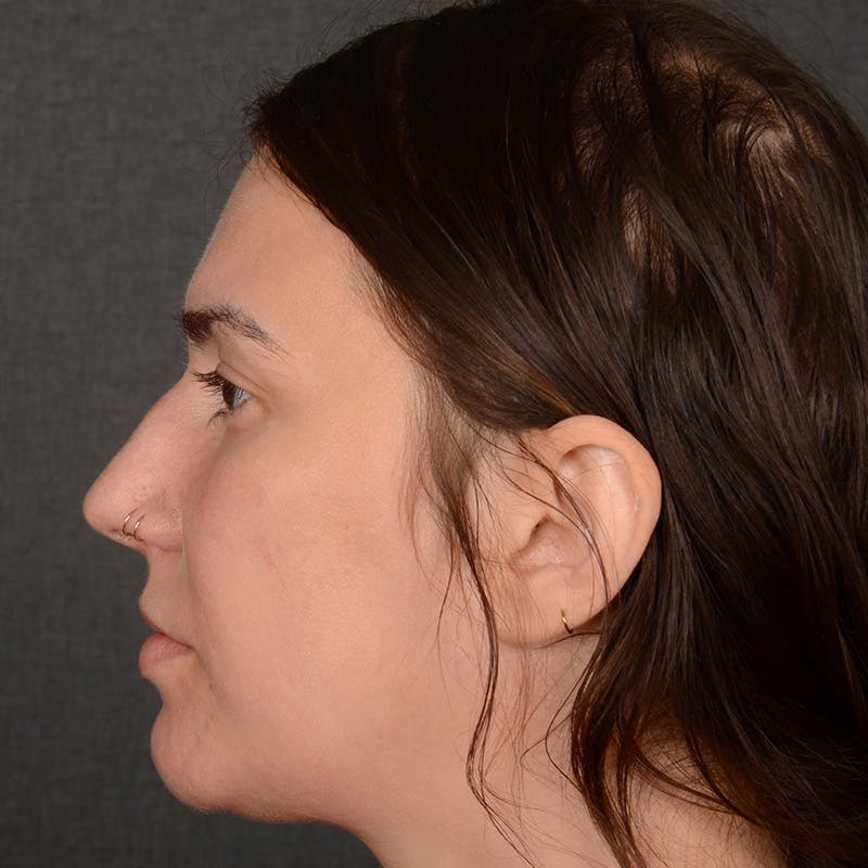 Female Rhinoplasty Before & After Gallery - Patient 259908 - Image 5