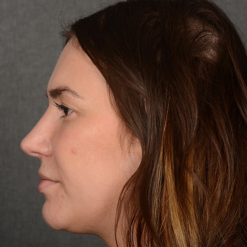 Female Rhinoplasty Before & After Gallery - Patient 259908 - Image 6
