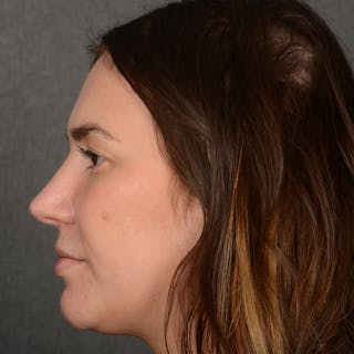 Female Rhinoplasty Before & After Gallery - Patient 259908 - Image 6