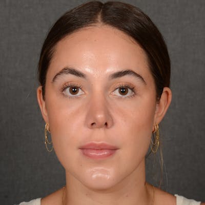 Female Rhinoplasty Before & After Gallery - Patient 995222 - Image 1