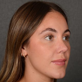 Female Rhinoplasty Before & After Gallery - Patient 995222 - Image 6