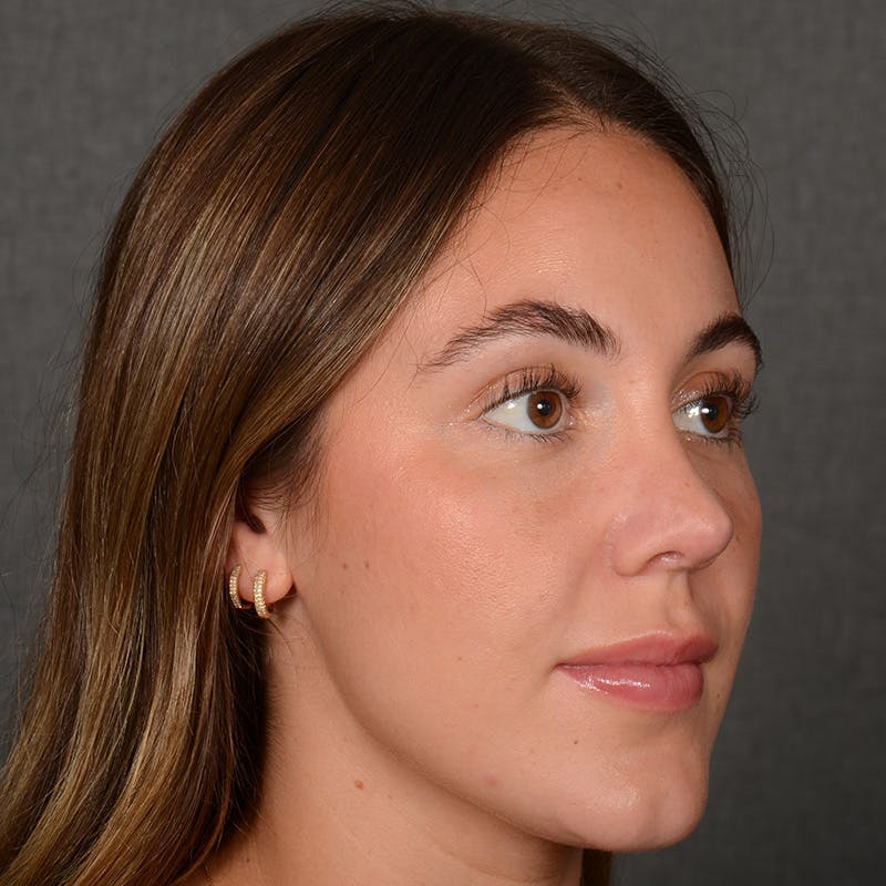 Female Rhinoplasty Before & After Gallery - Patient 995222 - Image 6