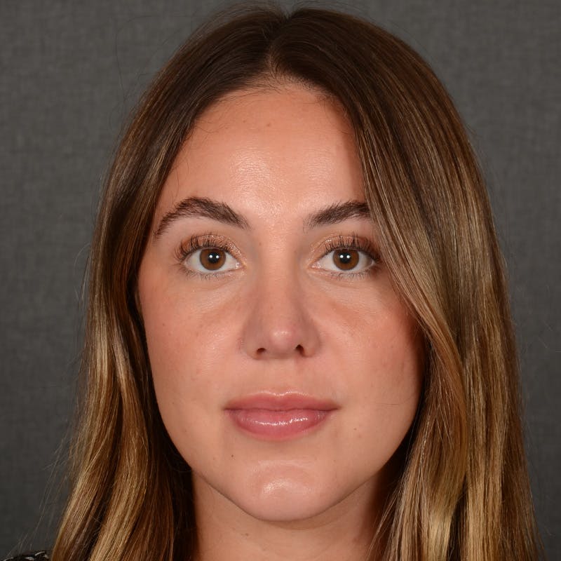 Female Rhinoplasty Before & After Gallery - Patient 995222 - Image 2