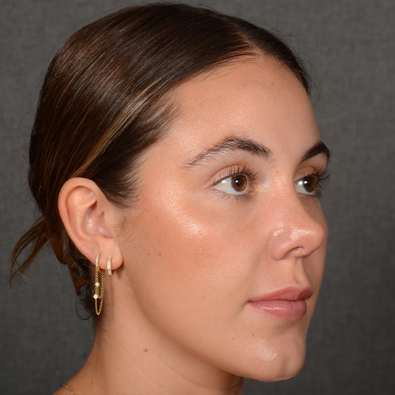 Female Rhinoplasty Before & After Gallery - Patient 995222 - Image 5