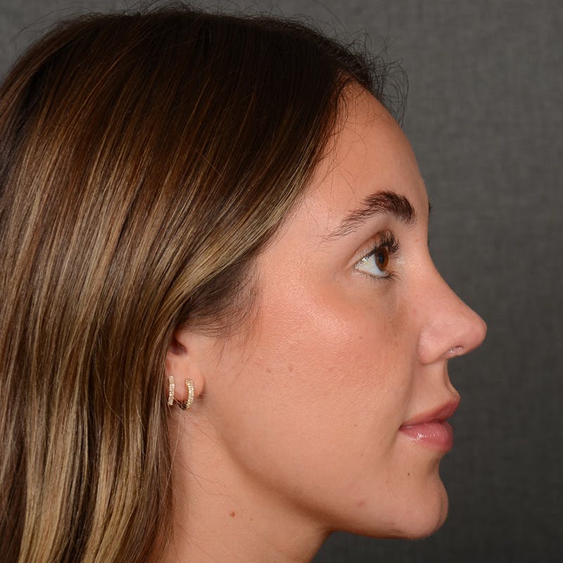 Female Rhinoplasty Before & After Gallery - Patient 995222 - Image 4