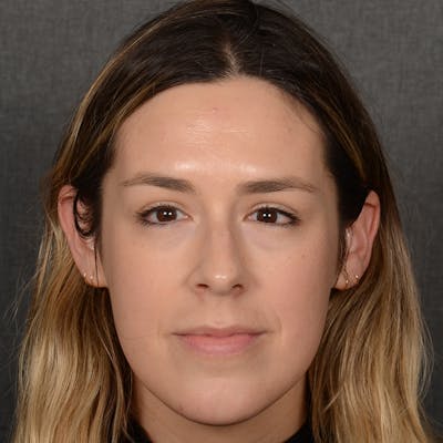 Female Rhinoplasty Before & After Gallery - Patient 130687 - Image 1