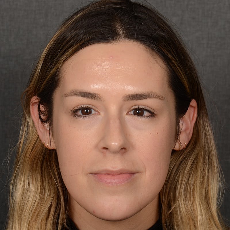 Female Rhinoplasty Before & After Gallery - Patient 130687 - Image 1