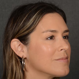 Female Rhinoplasty Before & After Gallery - Patient 130687 - Image 6