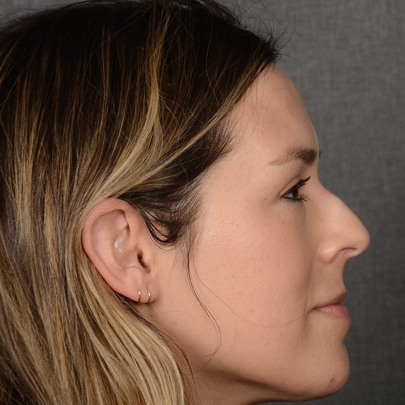 Female Rhinoplasty Before & After Gallery - Patient 130687 - Image 3