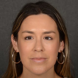 Female Rhinoplasty Before & After Gallery - Patient 130687 - Image 2