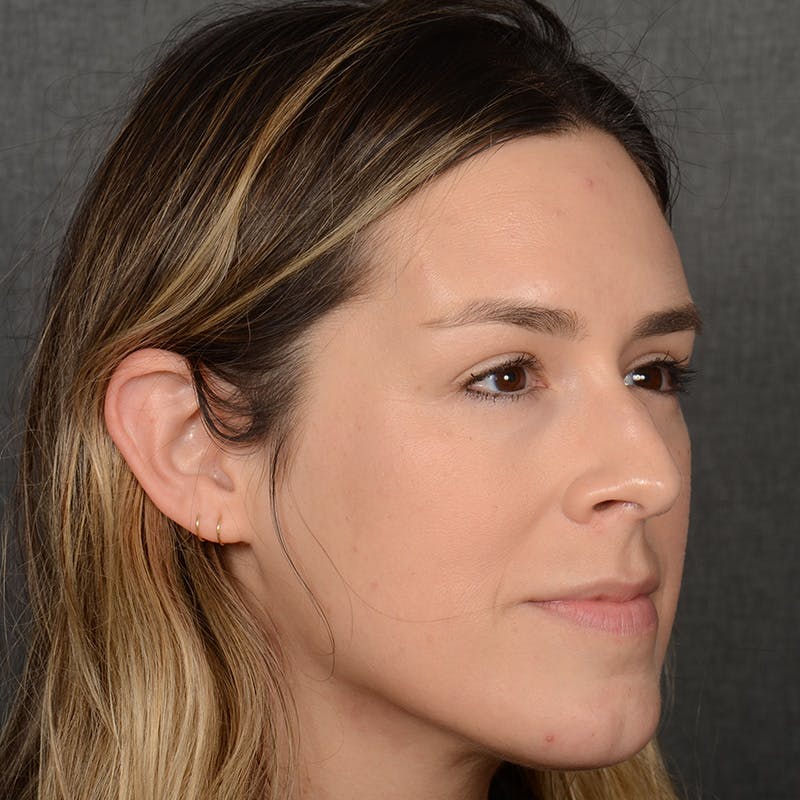 Female Rhinoplasty Before & After Gallery - Patient 130687 - Image 5