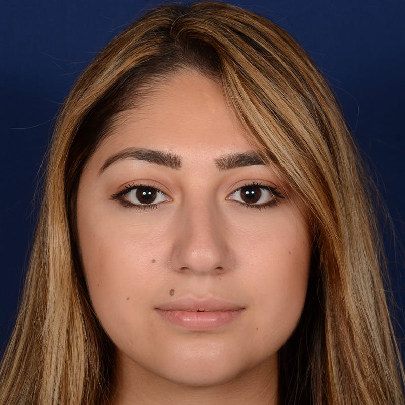 Female Rhinoplasty Before & After Gallery - Patient 347552 - Image 1
