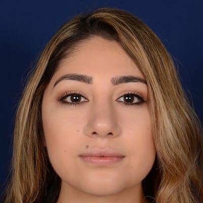 Female Rhinoplasty Before & After Gallery - Patient 347552 - Image 2