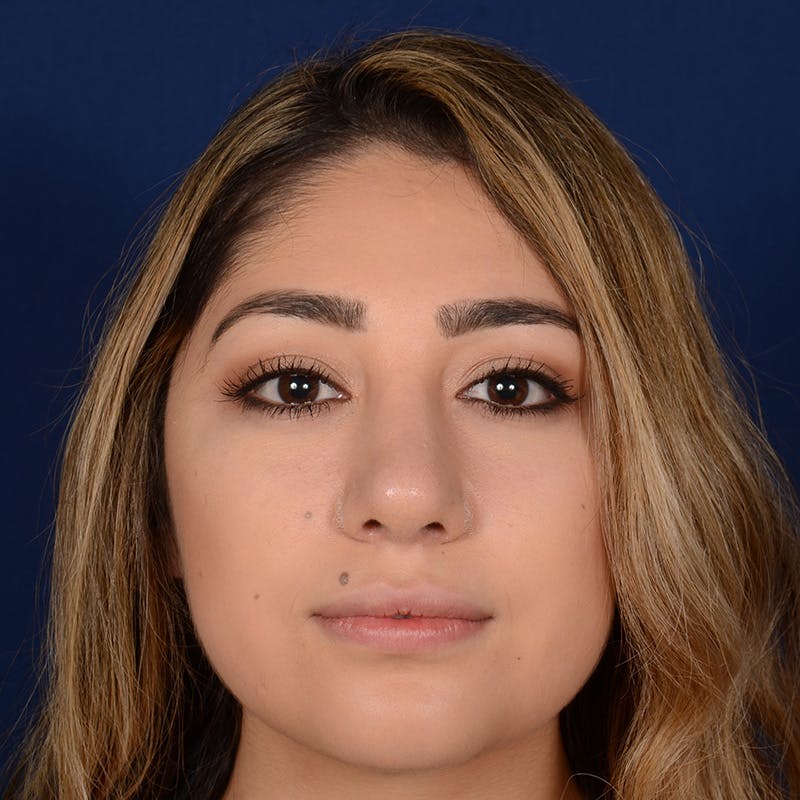 Female Rhinoplasty Before & After Gallery - Patient 347552 - Image 2