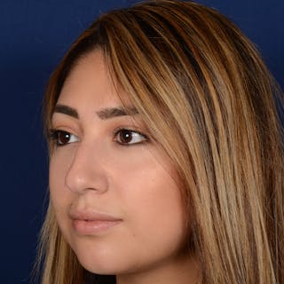 Female Rhinoplasty Before & After Gallery - Patient 347552 - Image 4