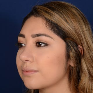 Female Rhinoplasty Before & After Gallery - Patient 347552 - Image 4