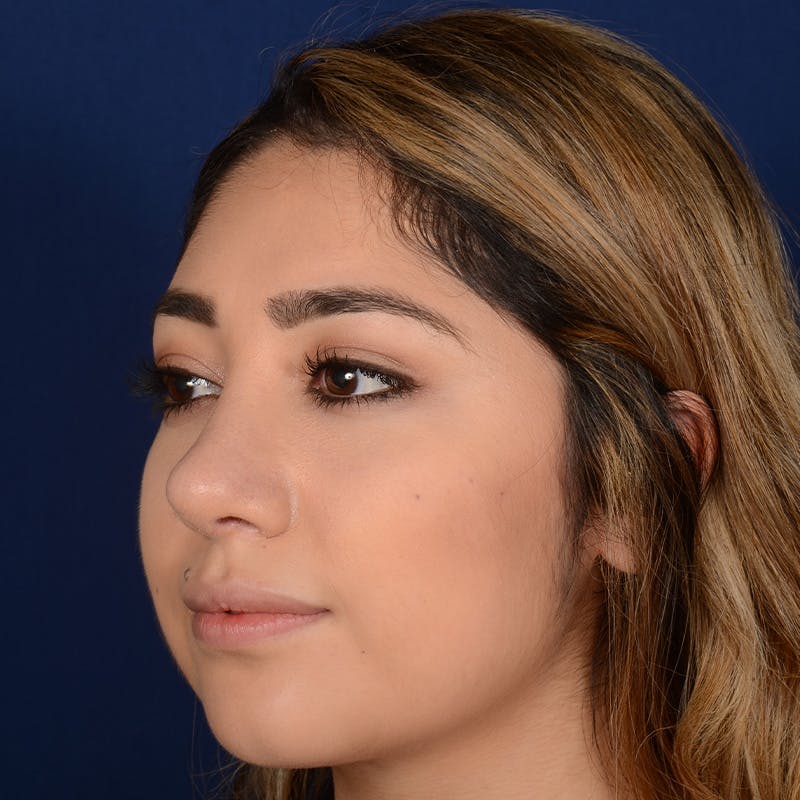 Female Rhinoplasty Before & After Gallery - Patient 347552 - Image 3