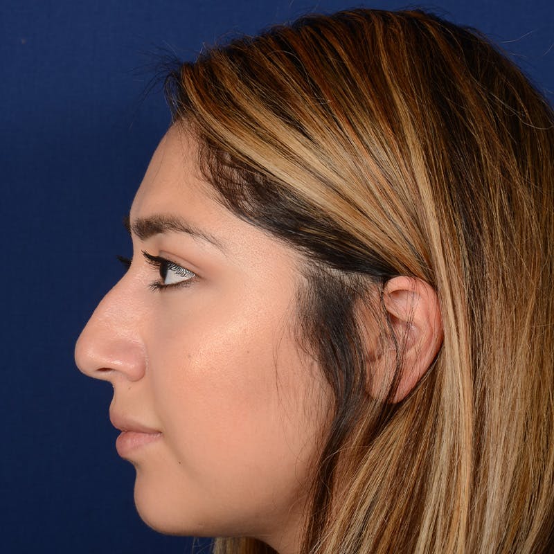 Female Rhinoplasty Before & After Gallery - Patient 347552 - Image 5