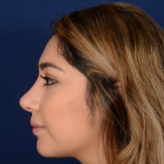 Female Rhinoplasty Before & After Gallery - Patient 347552 - Image 6