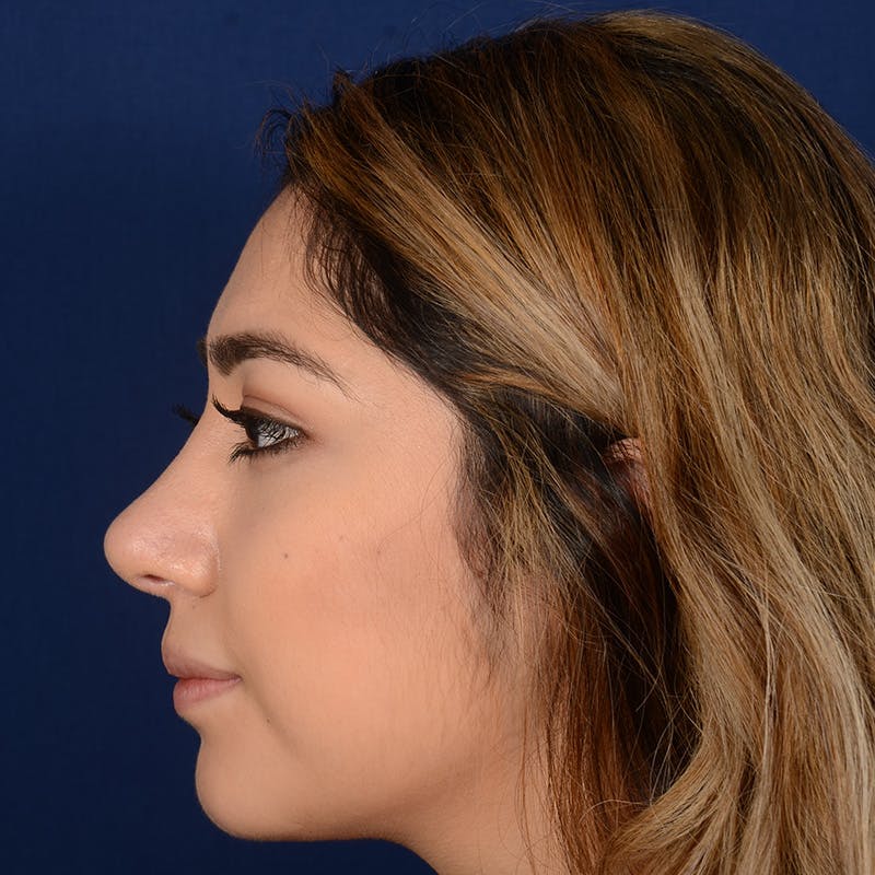 Female Rhinoplasty Before & After Gallery - Patient 347552 - Image 6