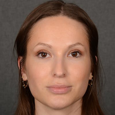 Female Rhinoplasty Before & After Gallery - Patient 356526 - Image 1