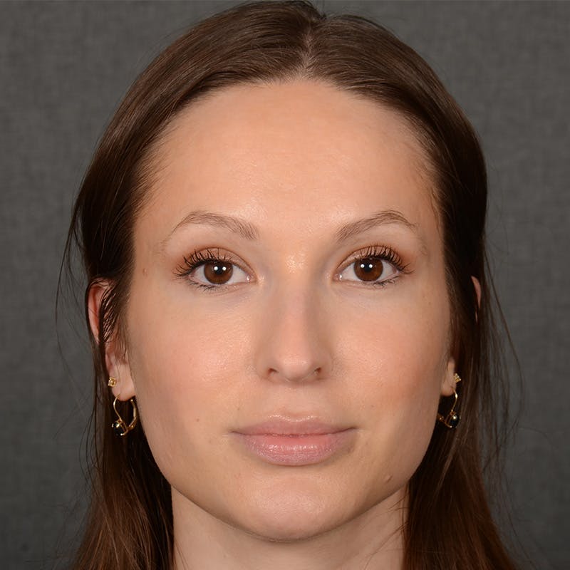 Female Rhinoplasty Before & After Gallery - Patient 356526 - Image 1