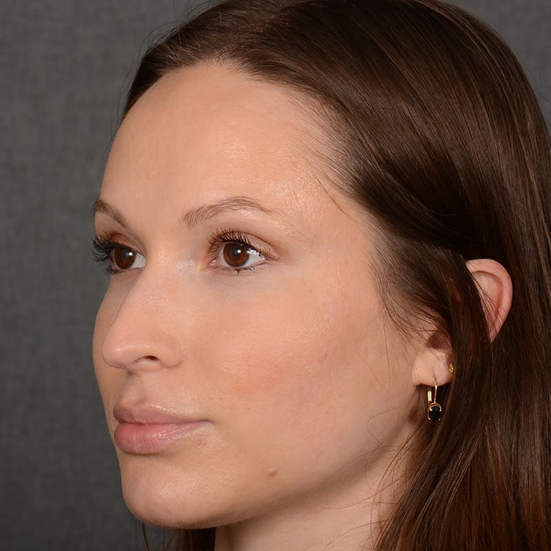 Female Rhinoplasty Before & After Gallery - Patient 356526 - Image 3