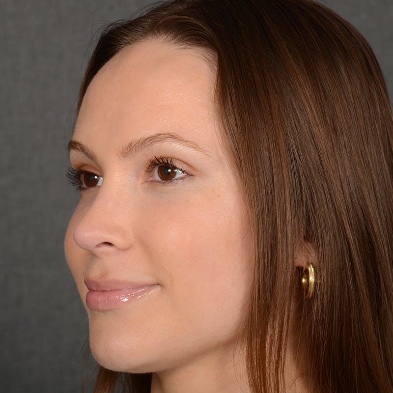 Female Rhinoplasty Before & After Gallery - Patient 356526 - Image 4