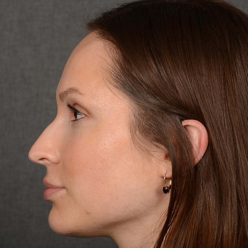Female Rhinoplasty Before & After Gallery - Patient 356526 - Image 5