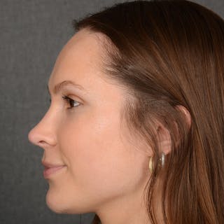 Female Rhinoplasty Before & After Gallery - Patient 356526 - Image 6