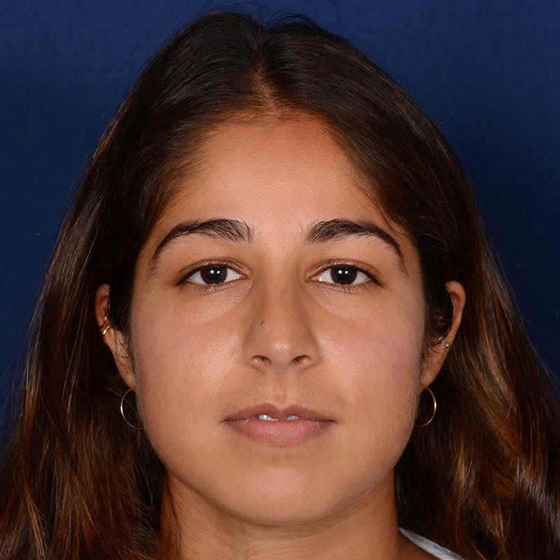 Female Rhinoplasty Before & After Gallery - Patient 323244 - Image 1