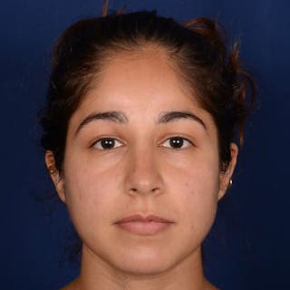 Female Rhinoplasty Before & After Gallery - Patient 323244 - Image 2