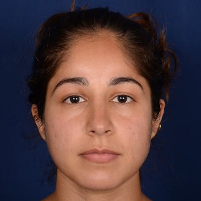 Female Rhinoplasty Before & After Gallery - Patient 323244 - Image 2