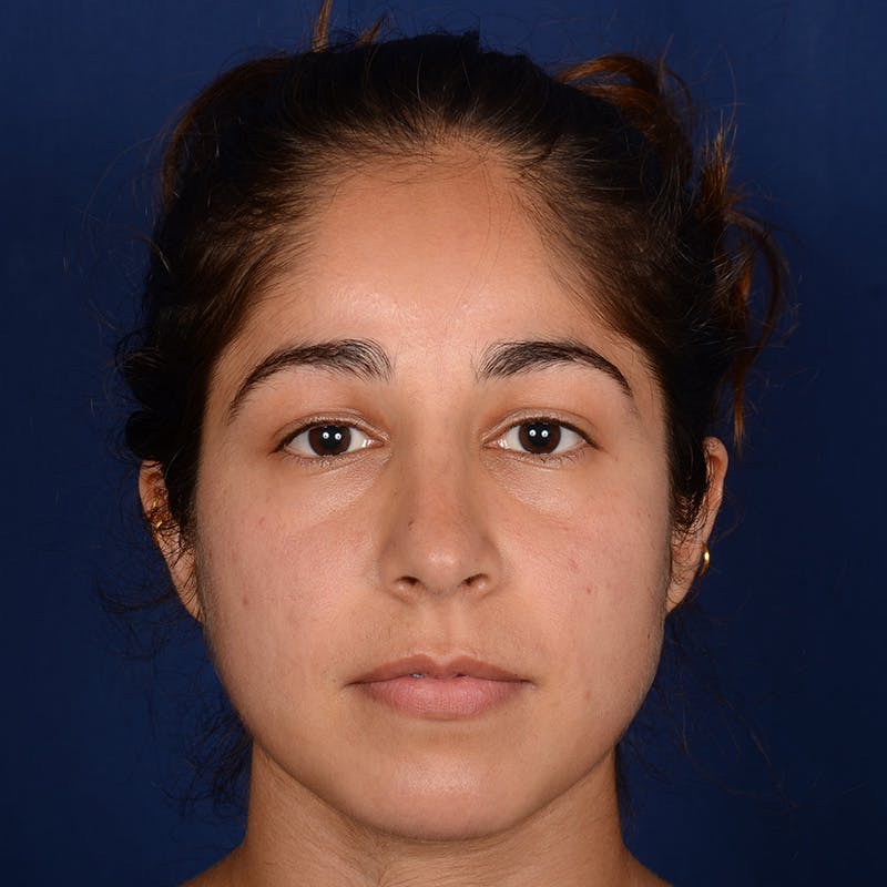 Female Rhinoplasty Before & After Gallery - Patient 323244 - Image 2