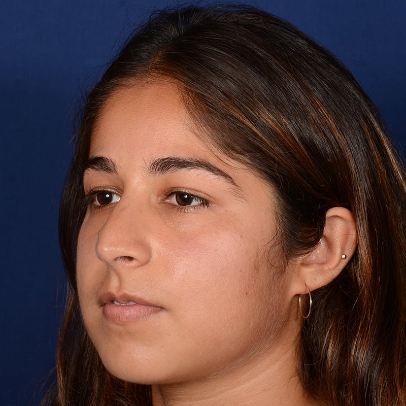 Female Rhinoplasty Before & After Gallery - Patient 323244 - Image 3