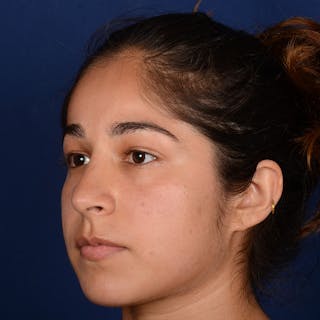 Female Rhinoplasty Before & After Gallery - Patient 323244 - Image 4