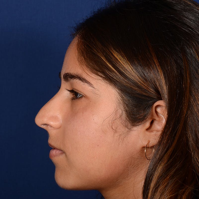 Female Rhinoplasty Before & After Gallery - Patient 323244 - Image 5