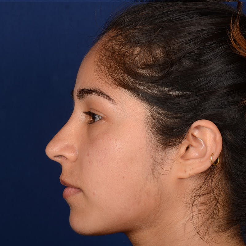 Female Rhinoplasty Before & After Gallery - Patient 323244 - Image 6
