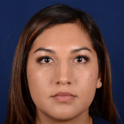 Female Rhinoplasty Before & After Gallery - Patient 229844 - Image 1