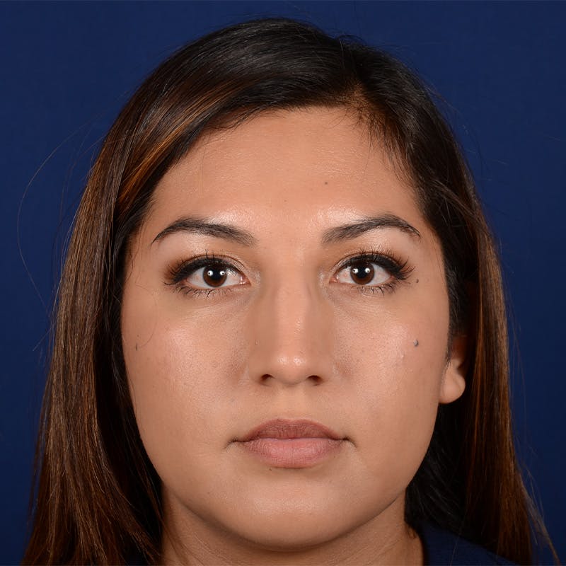 Female Rhinoplasty Before & After Gallery - Patient 229844 - Image 1