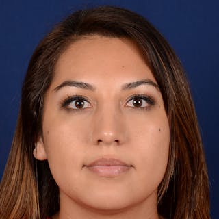 Female Rhinoplasty Before & After Gallery - Patient 229844 - Image 2