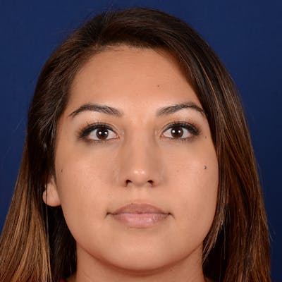 Female Rhinoplasty Before & After Gallery - Patient 229844 - Image 2
