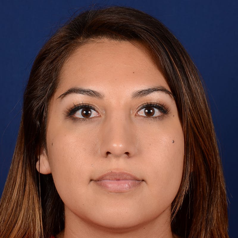 Female Rhinoplasty Before & After Gallery - Patient 229844 - Image 2