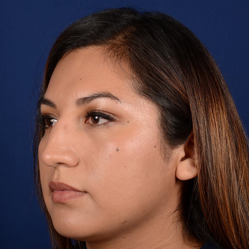 Female Rhinoplasty Before & After Gallery - Patient 229844 - Image 3