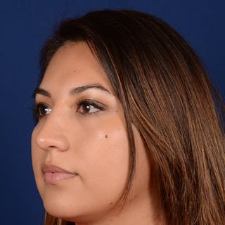 Female Rhinoplasty Before & After Gallery - Patient 229844 - Image 4