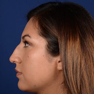 Female Rhinoplasty Before & After Gallery - Patient 229844 - Image 6